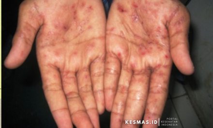 Penyakit Kulit Menular Yang Sering Terjadi Di Lingkungan Padat